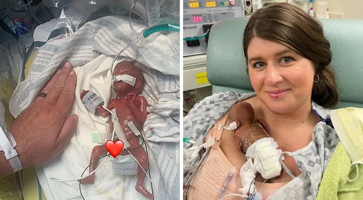 Bebé de Iowa Bate Récord Guinness como el Más Prematuro del Mundo al Nacer a las 21 Semanas
