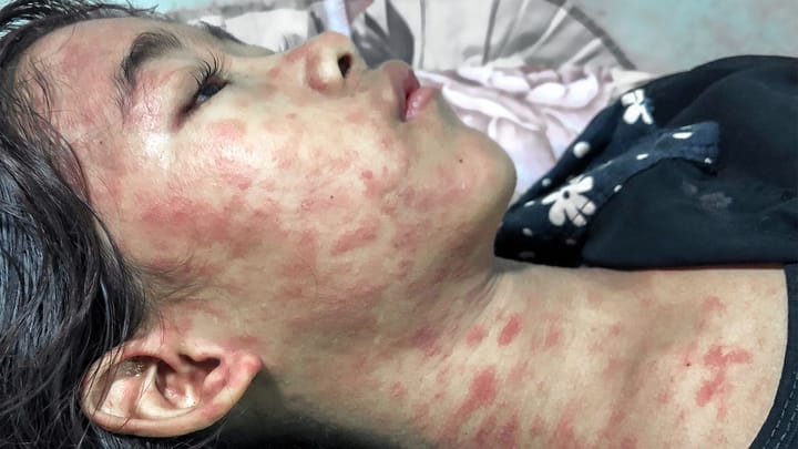 China Reactiva Controles Sanitarios Tipo COVID por Brote de Chikungunya en Guangdong
